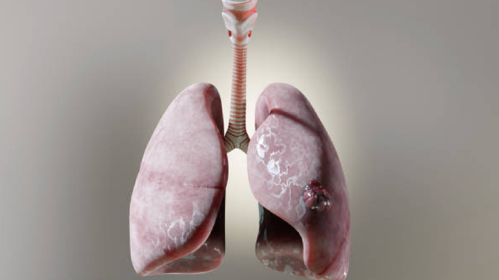 Lung Nodules & Lung Cancer